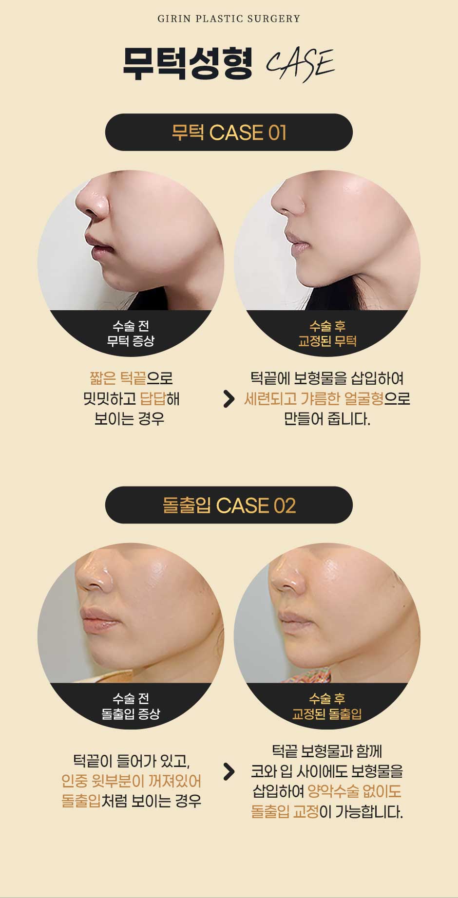 보형물윤곽성형_미인하이_06.jpg