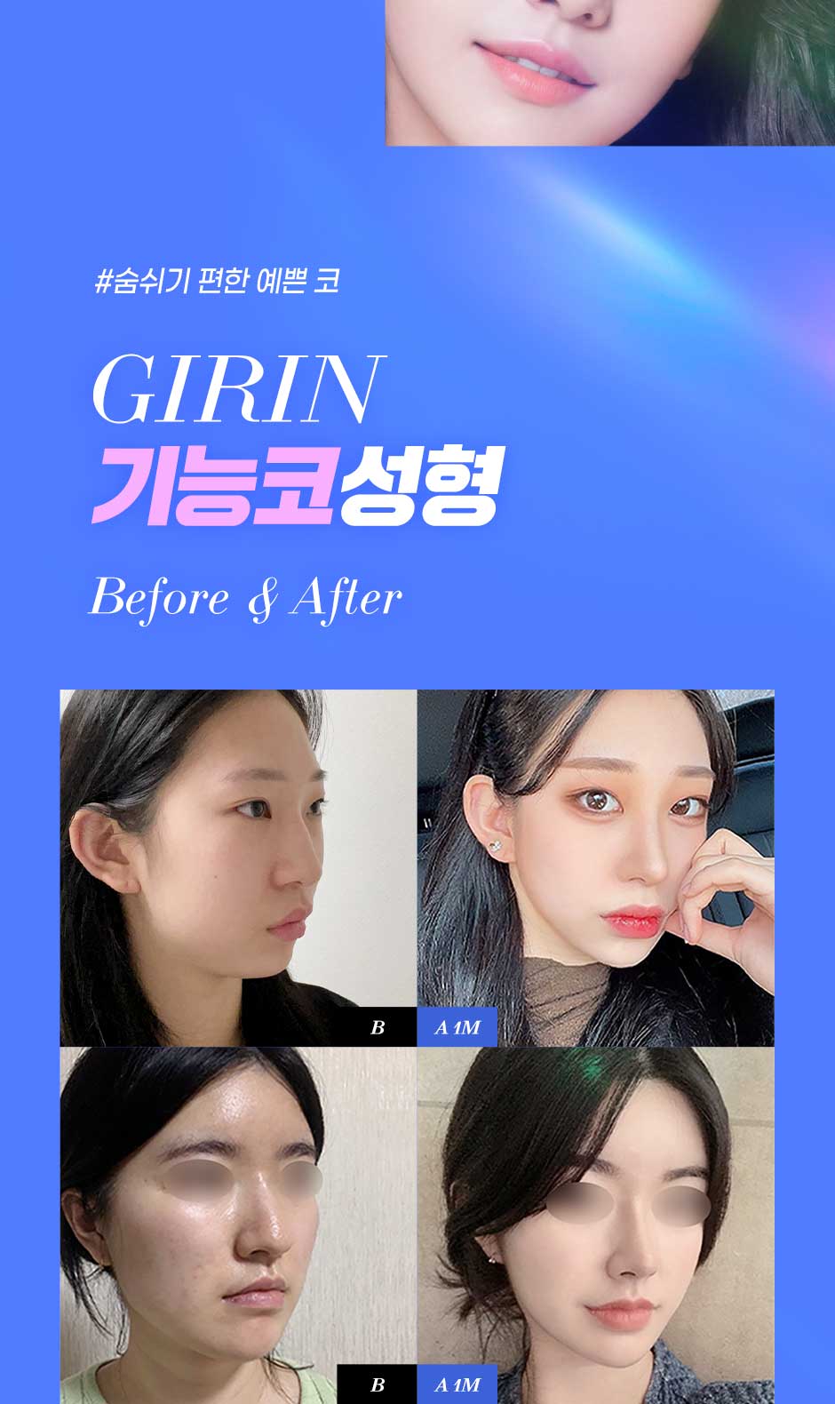 기능코성형_02.jpg