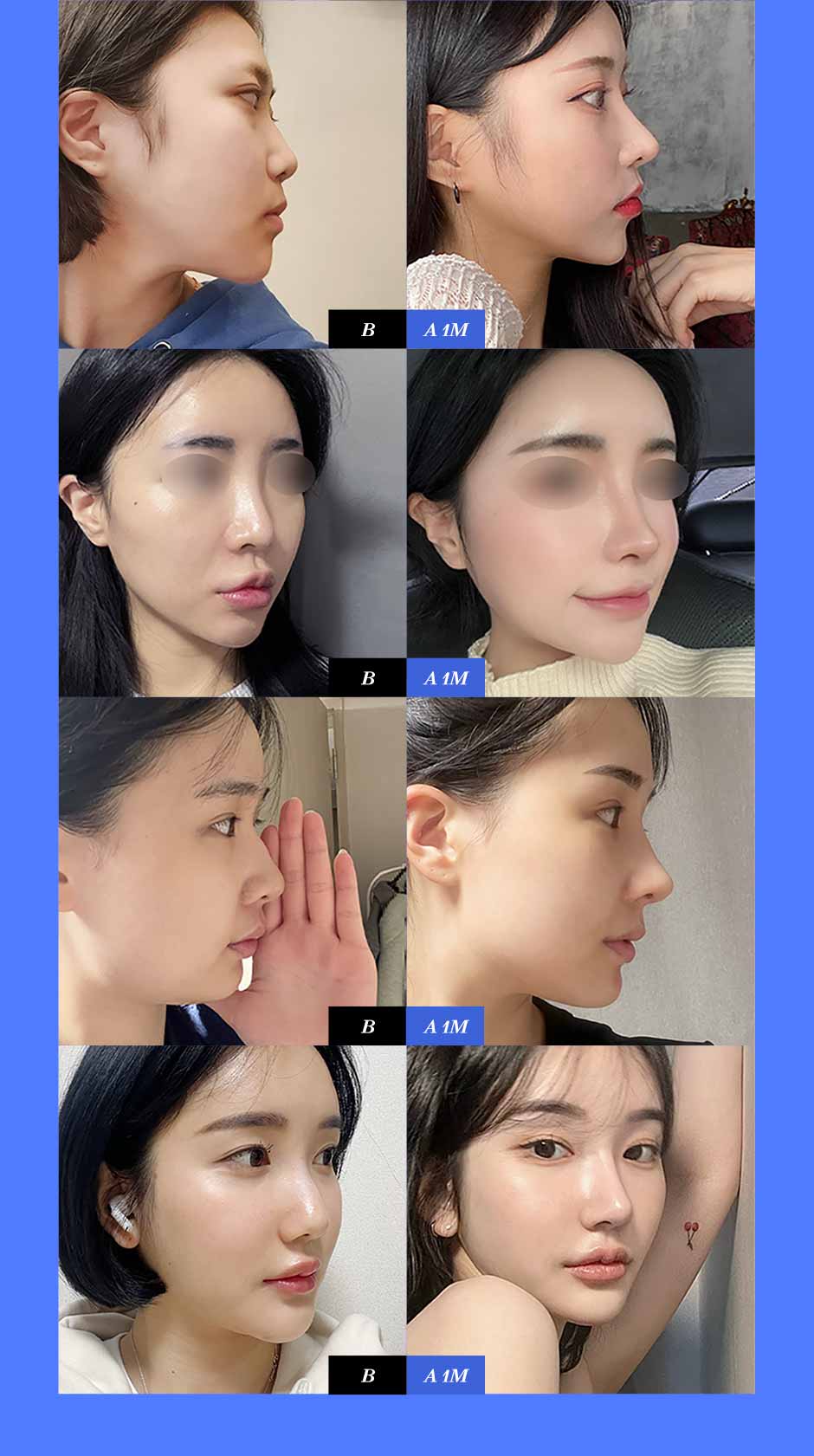 기능코성형_03.jpg
