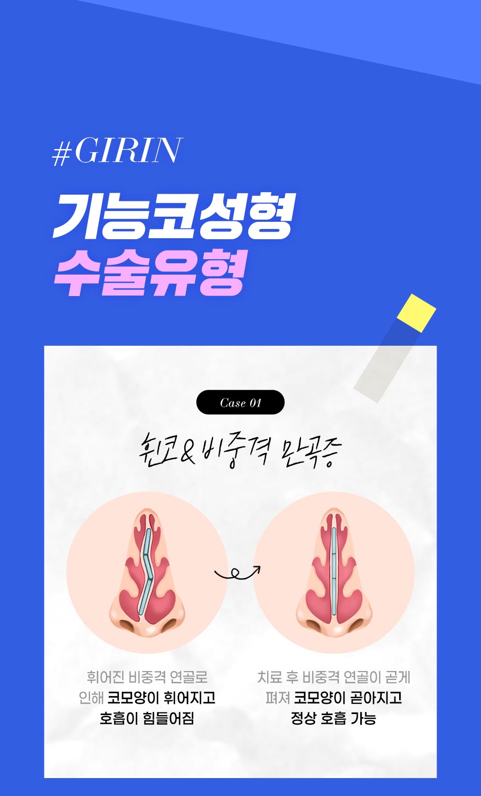 기능코성형_05.jpg