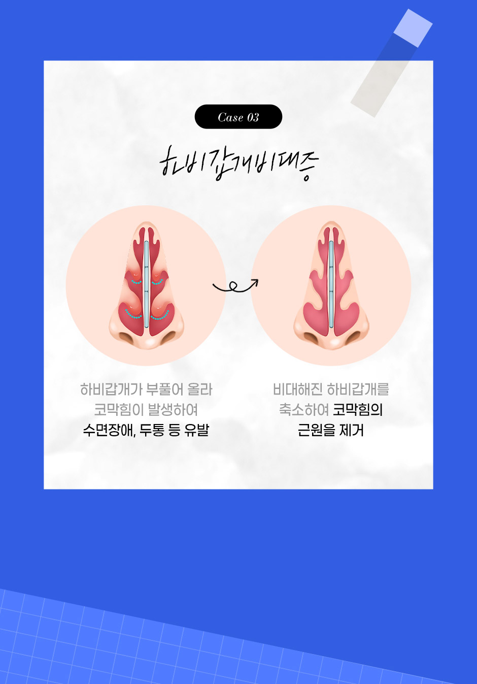 기능코성형_07.jpg