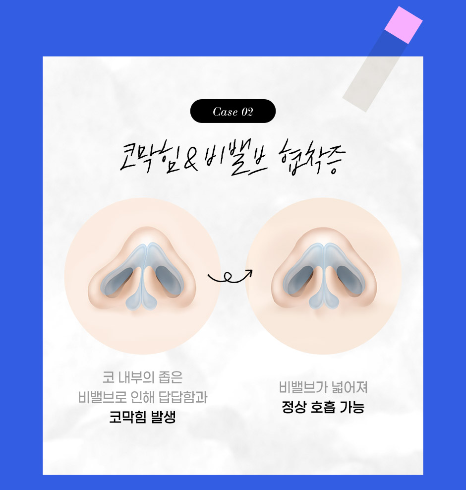 기능코성형_06.jpg