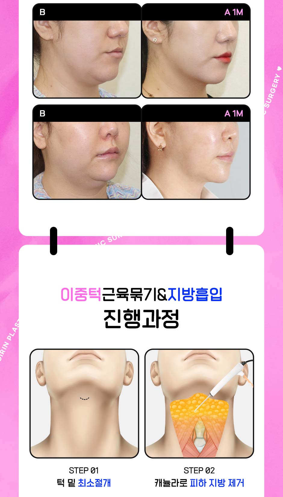 이중턱근육묶기&얼굴지흡_04.jpg