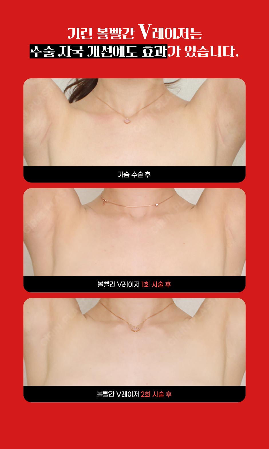 볼빨간V레이저_06.jpg