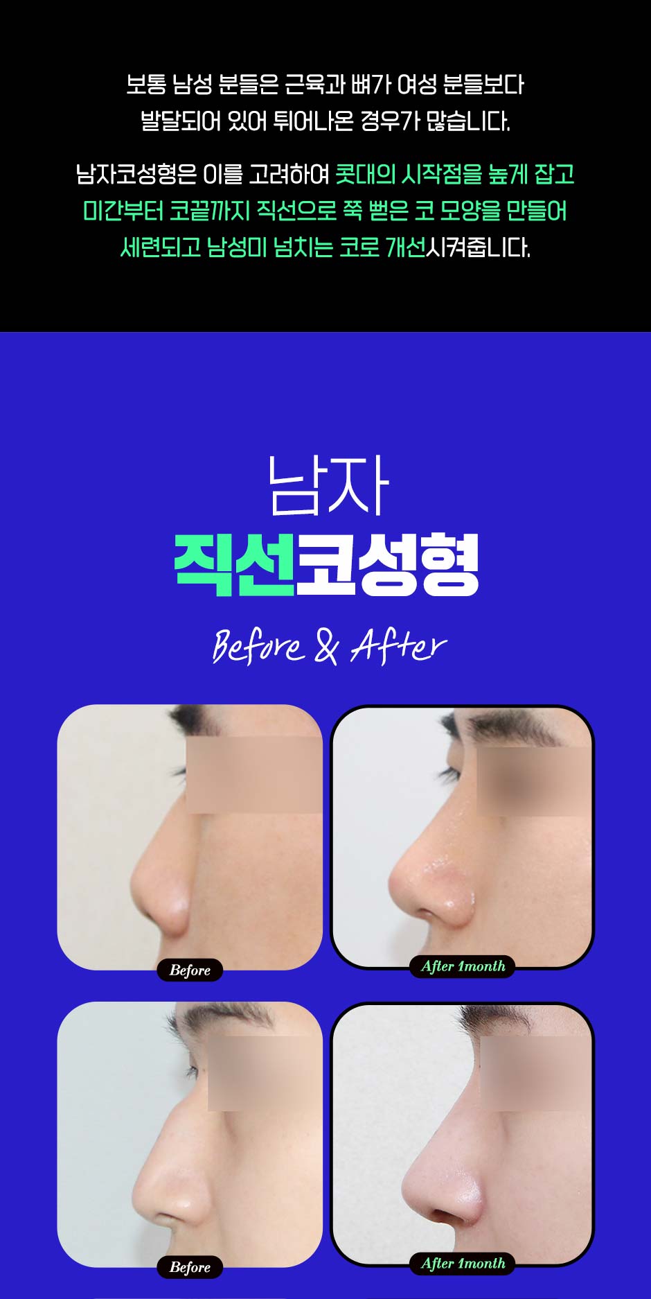 남자직선코성형_05.jpg