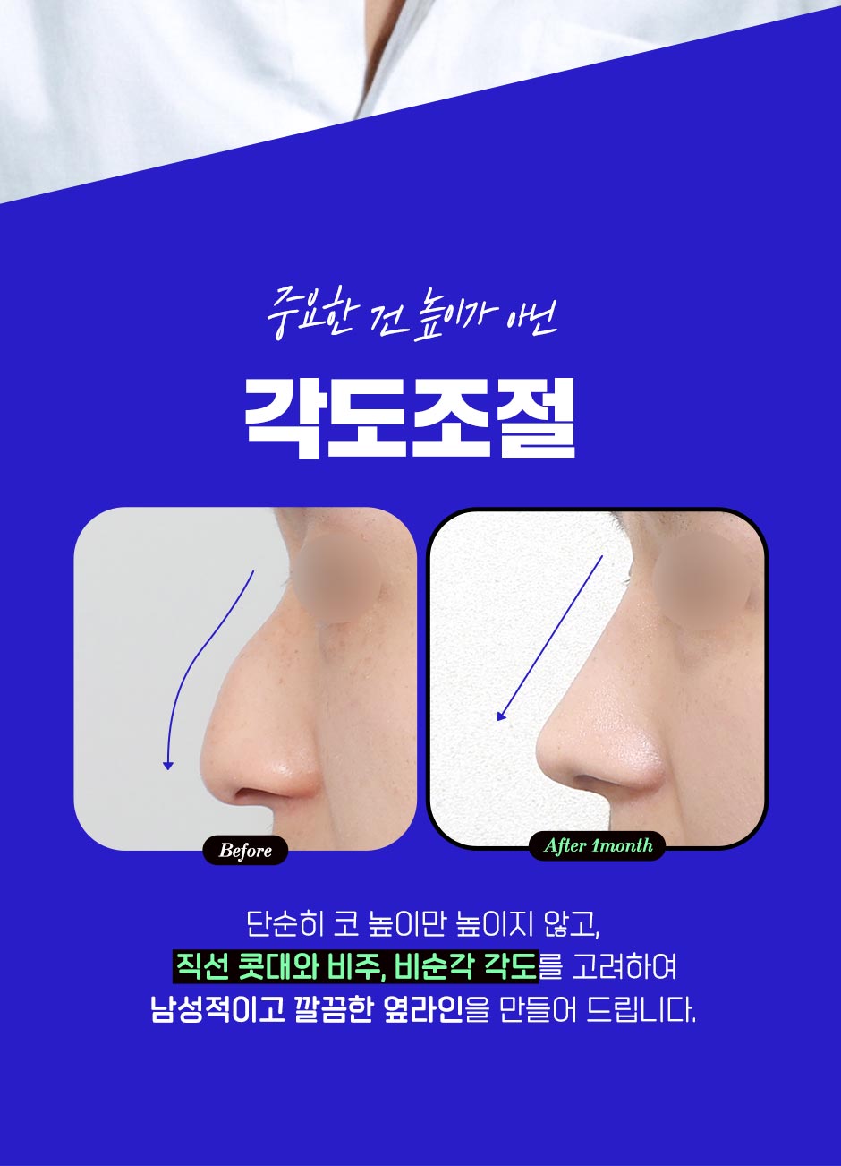 남자직선코성형_02.jpg