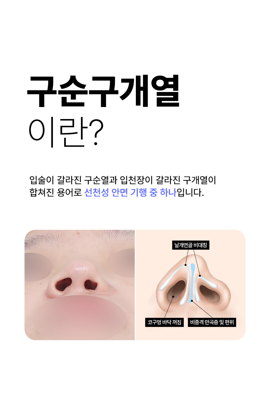 구순구개열코성형_02.jpg