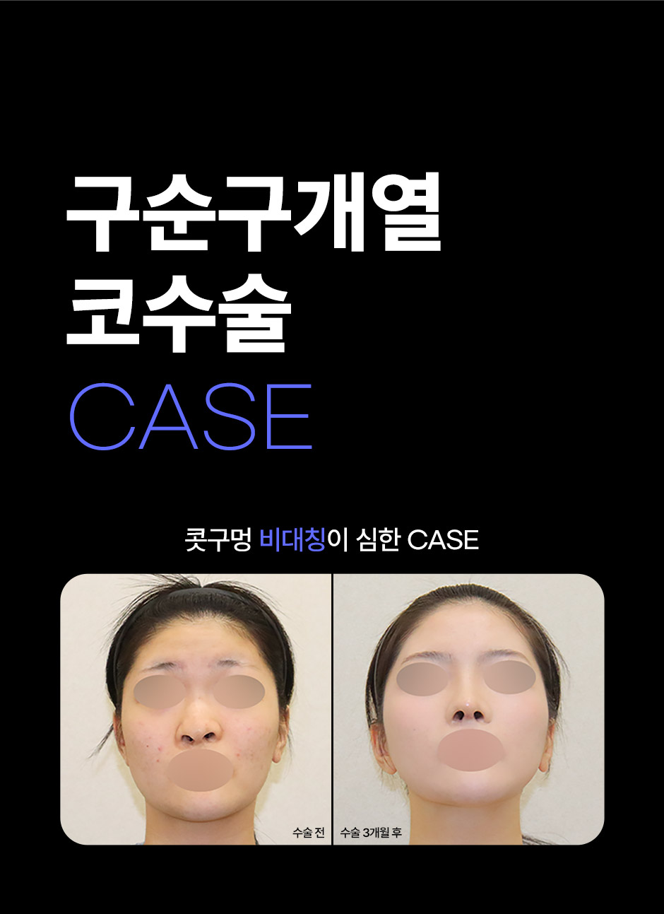 구순구개열코성형_03.jpg