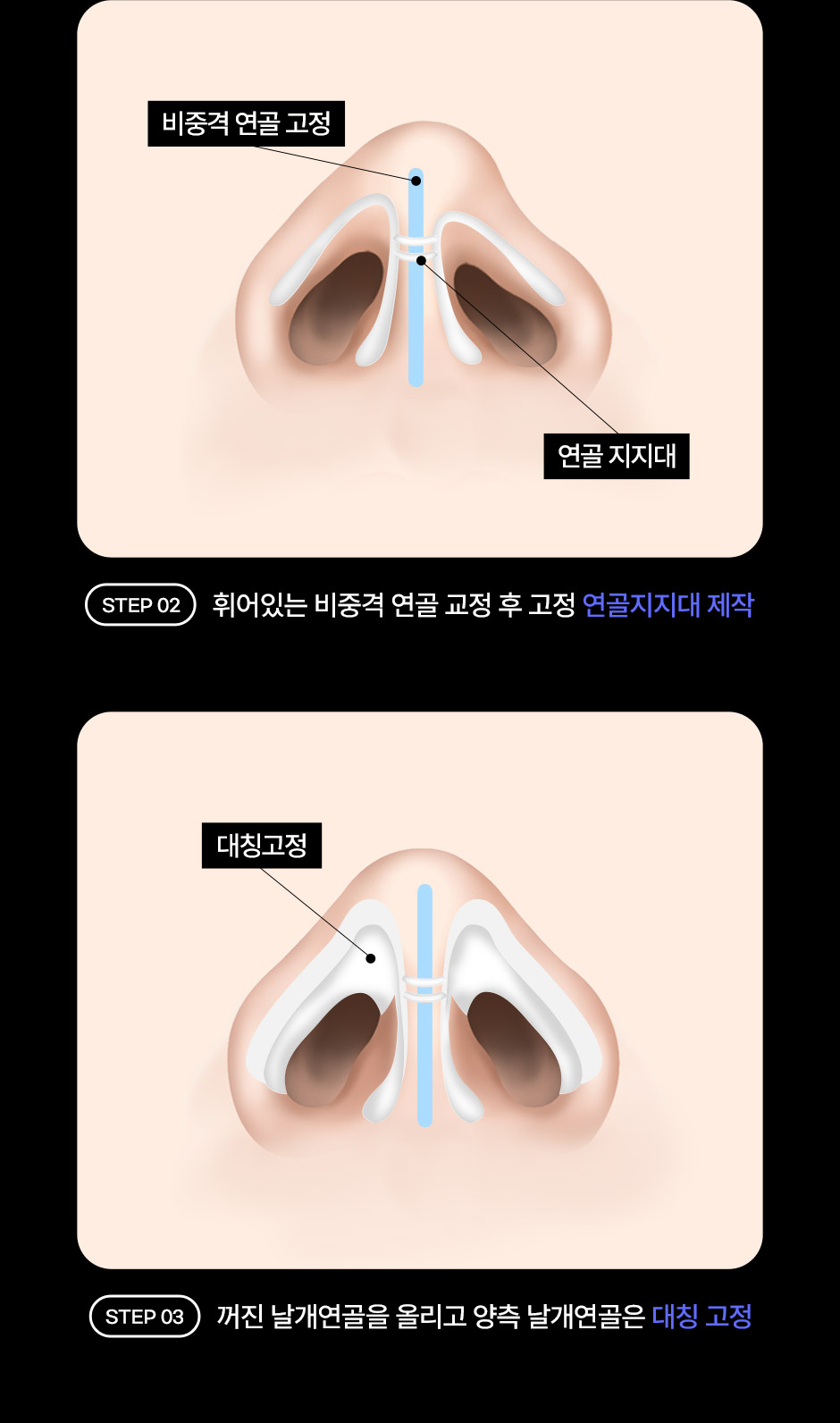 구순구개열코성형_07.jpg