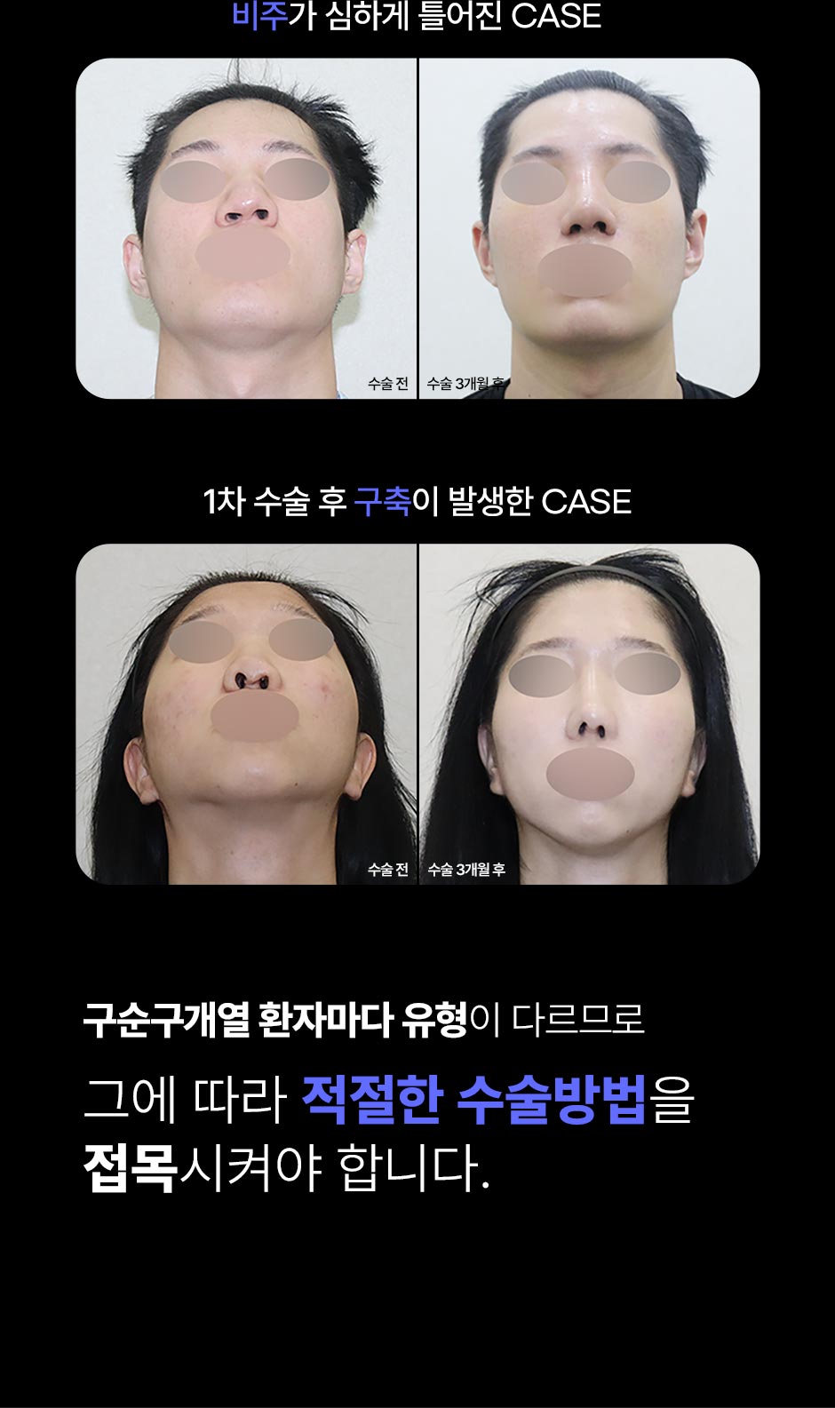 구순구개열코성형_04.jpg