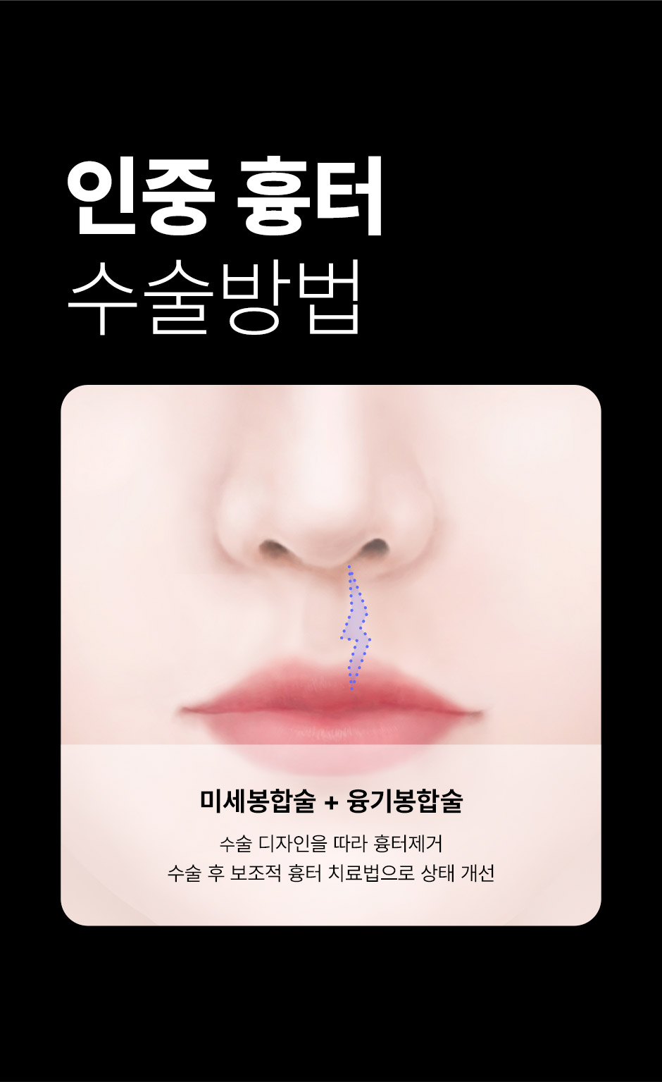 구순구개열코성형_10.jpg