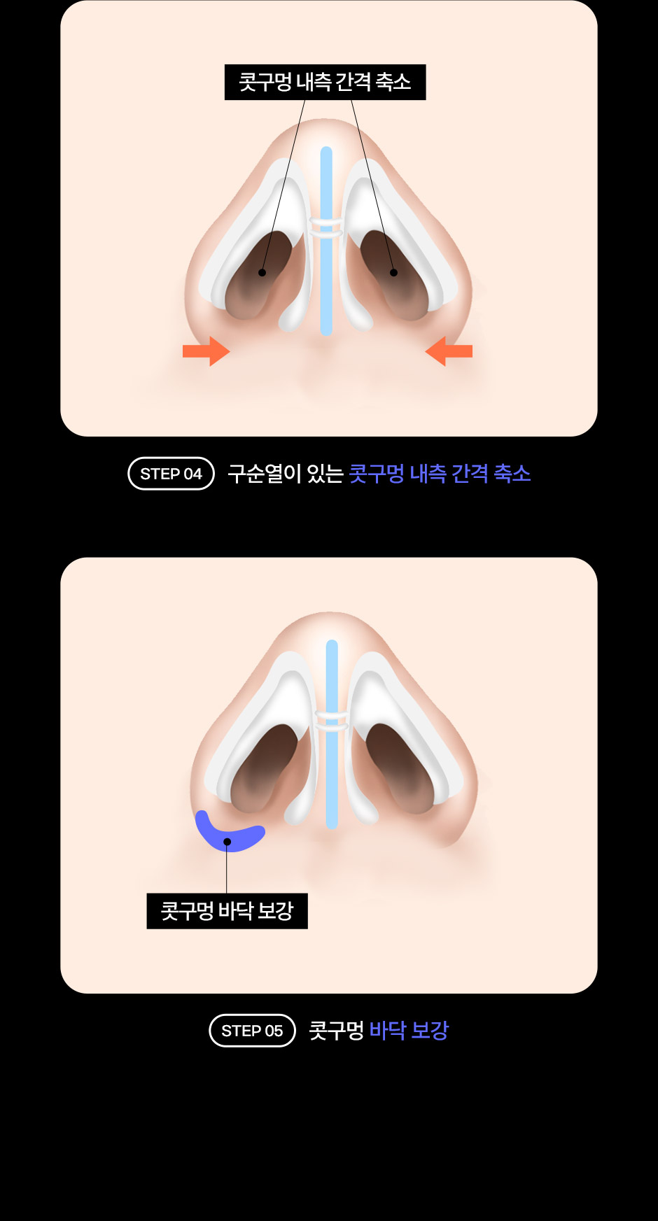 구순구개열코성형_08.jpg