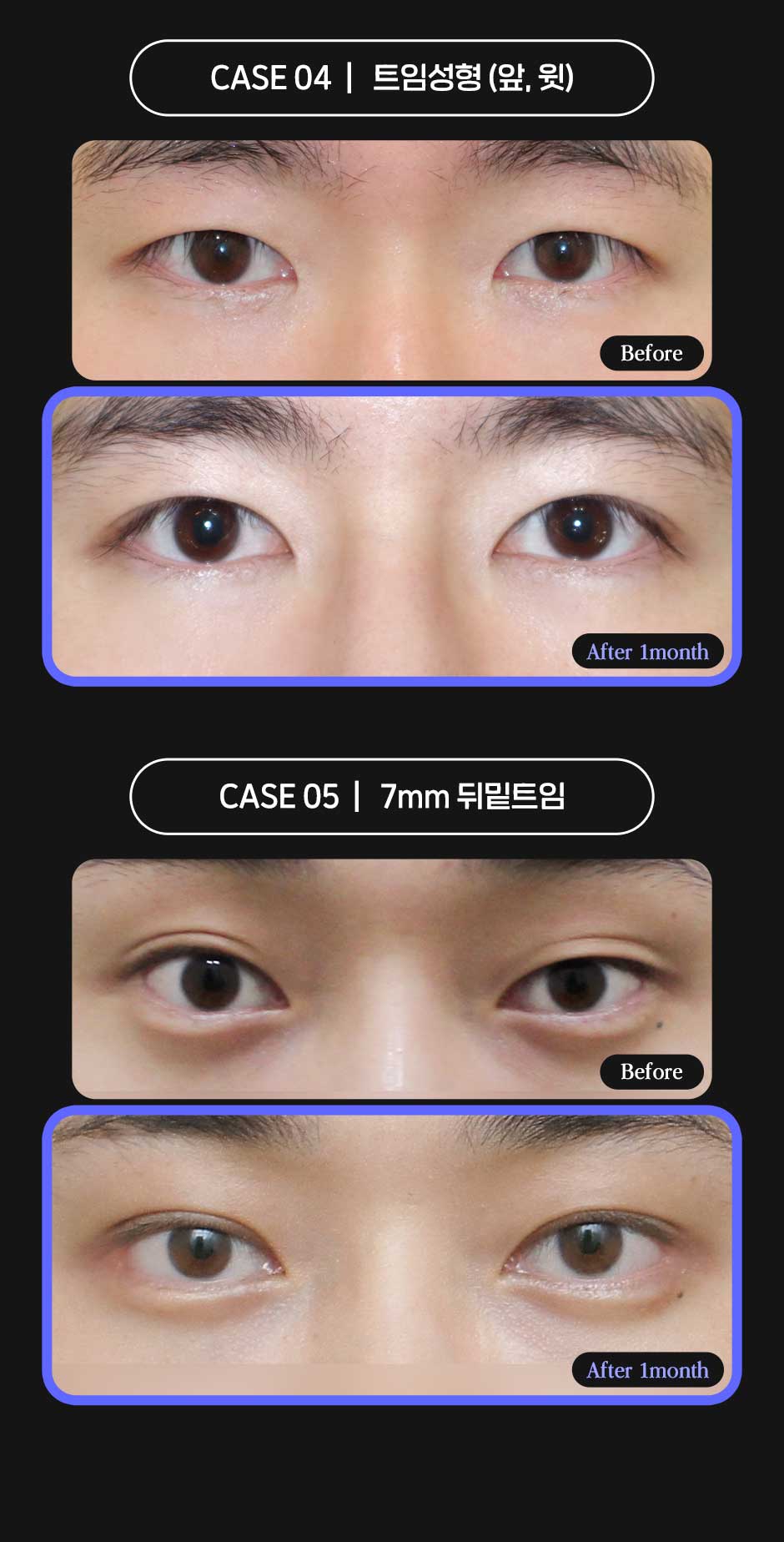 남자눈성형_06.jpg