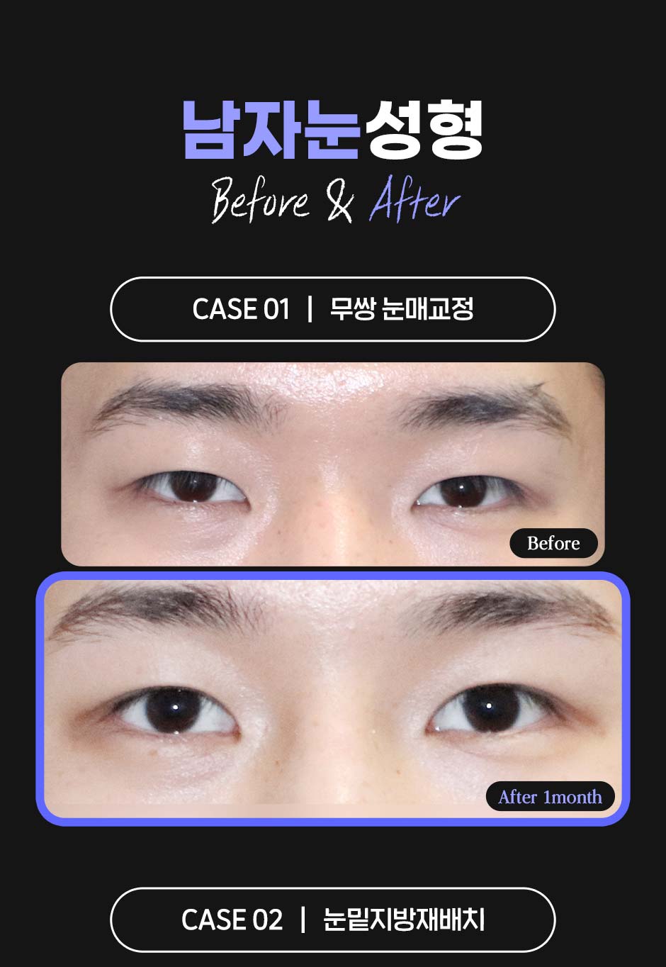 남자눈성형_04.jpg