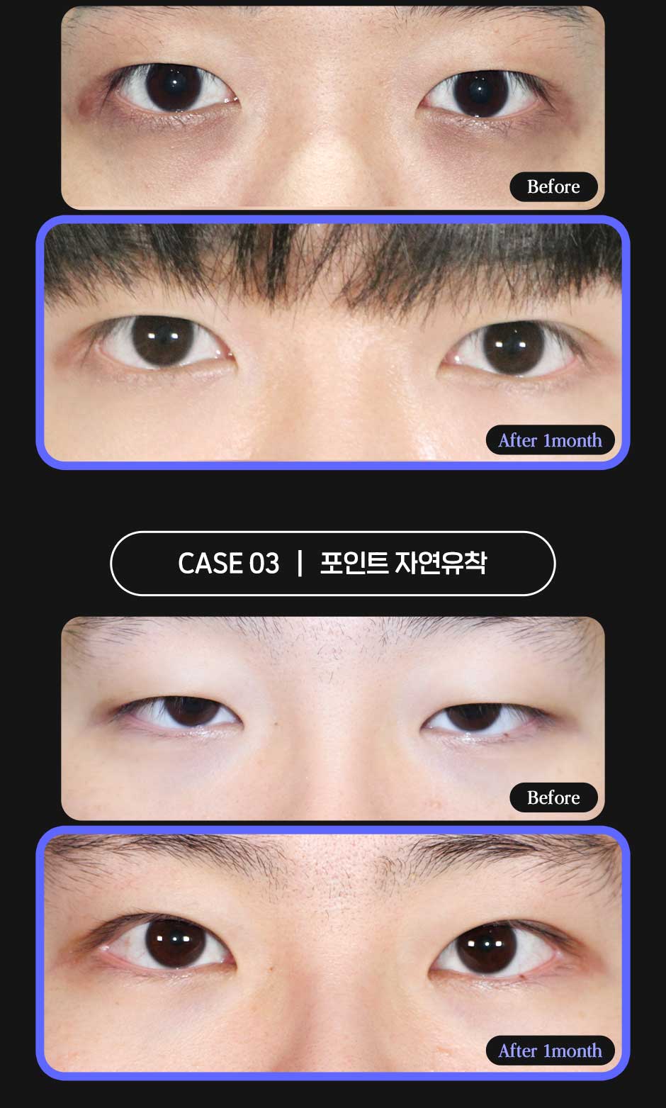 남자눈성형_05.jpg