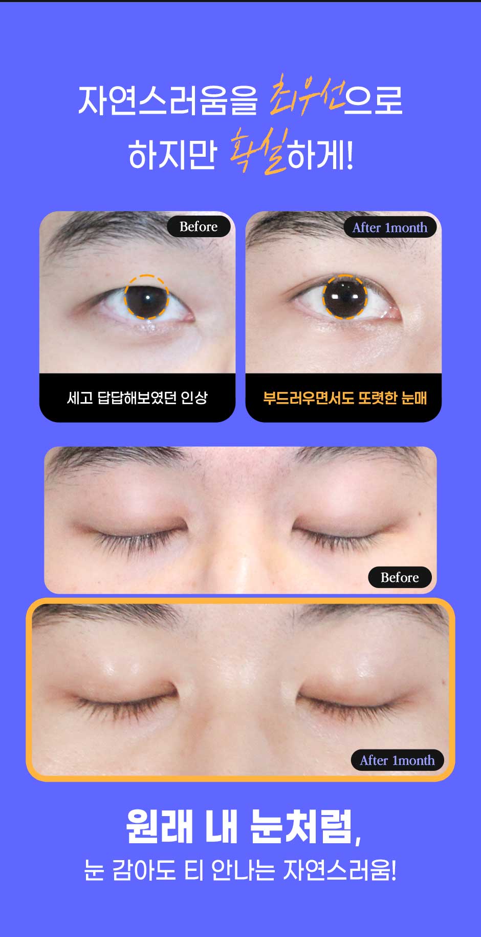 남자눈성형_07.jpg