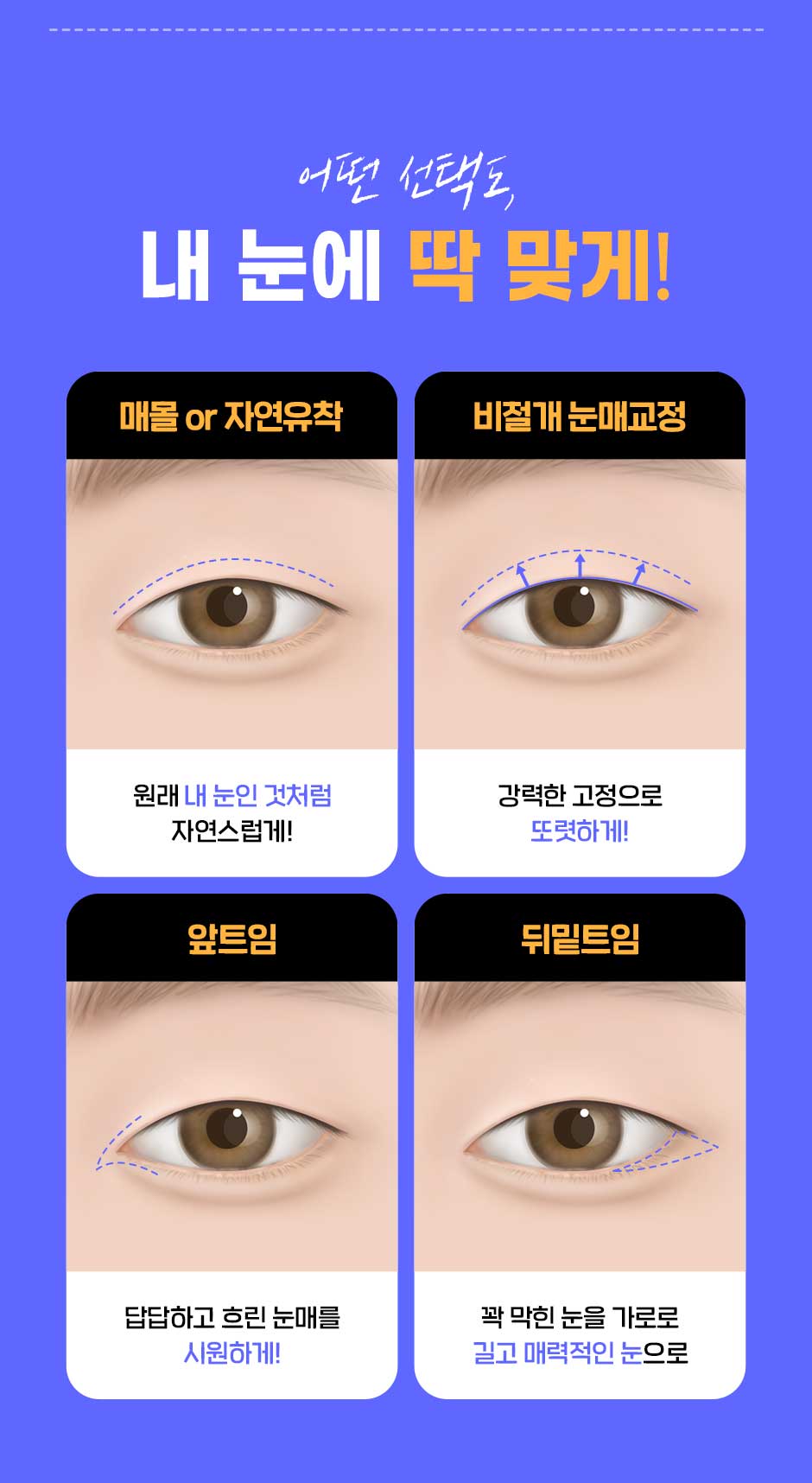 남자눈성형_08.jpg
