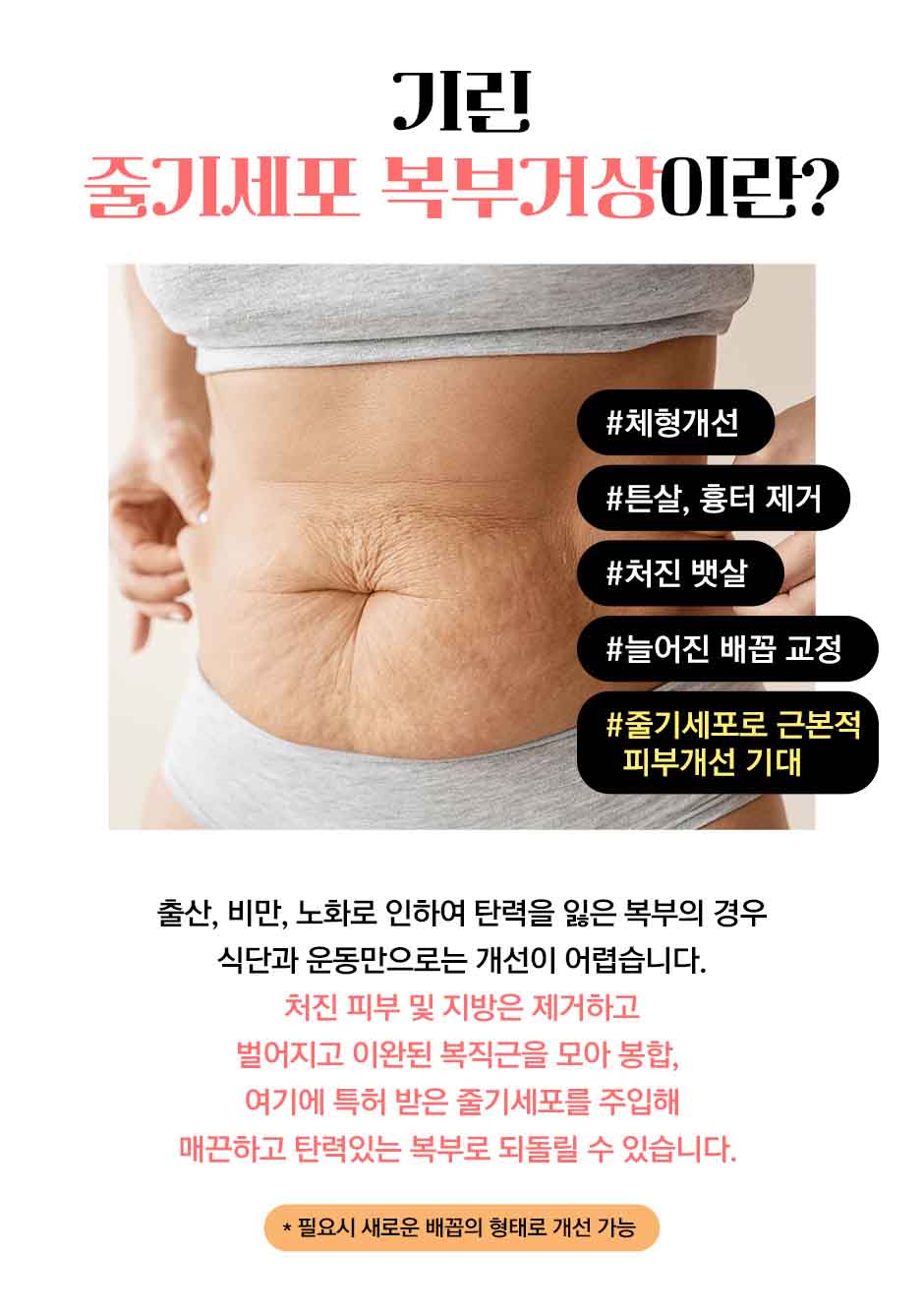 줄기세포복부거상_미인하이_02.jpg