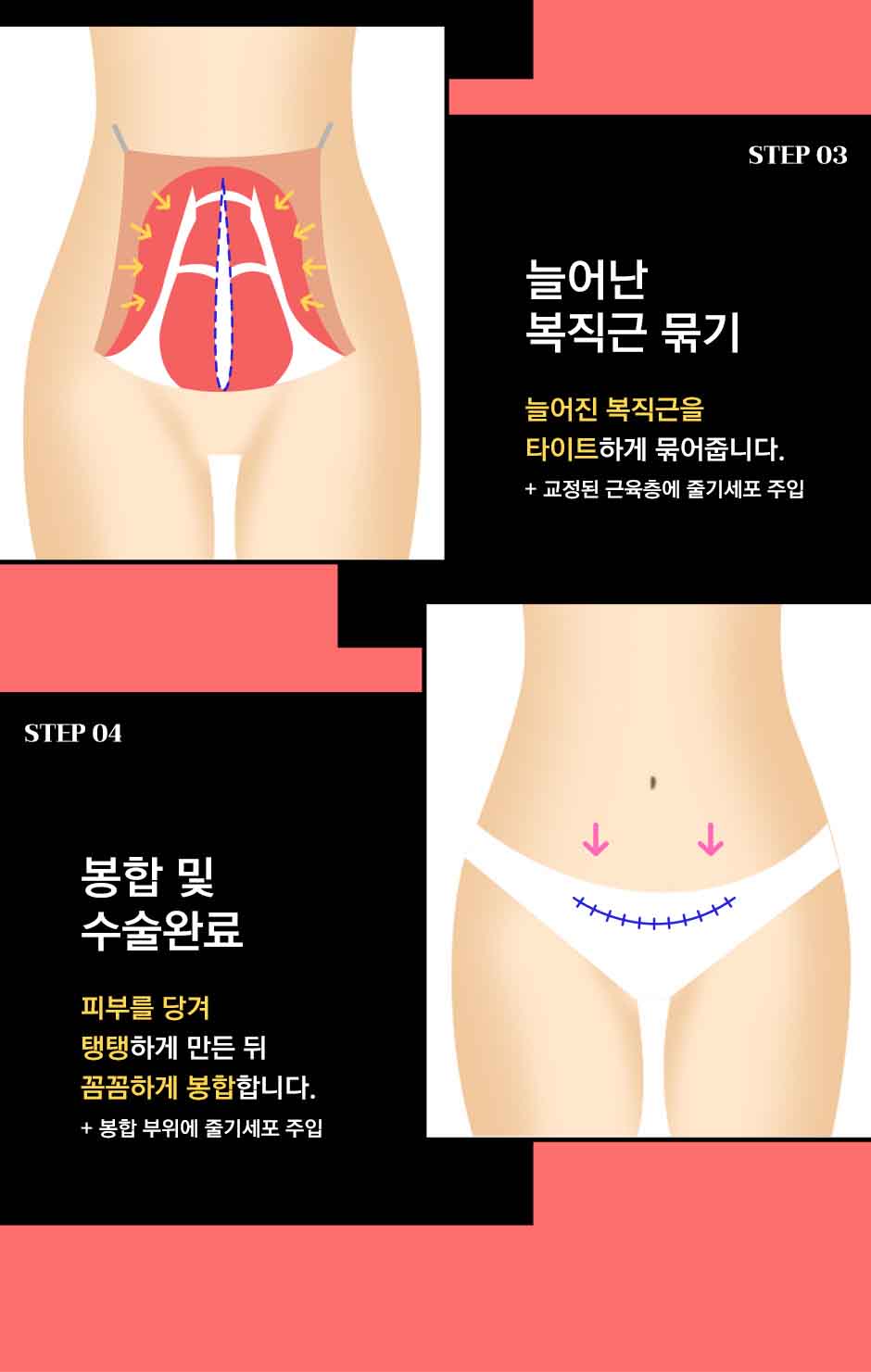 줄기세포복부거상_미인하이_08.jpg