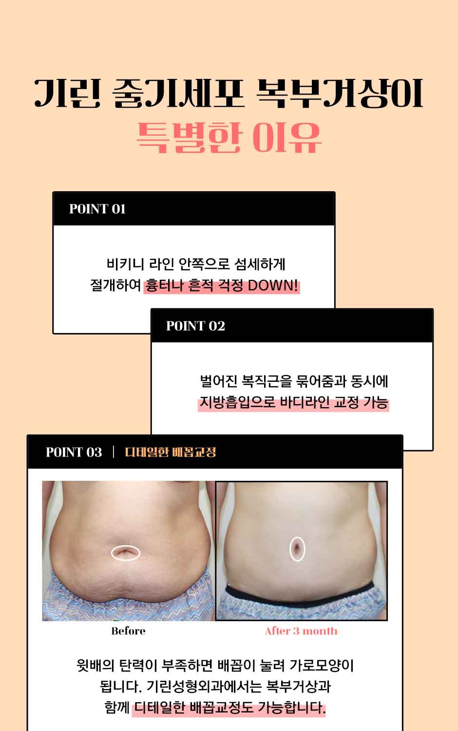 줄기세포복부거상_미인하이_09.jpg