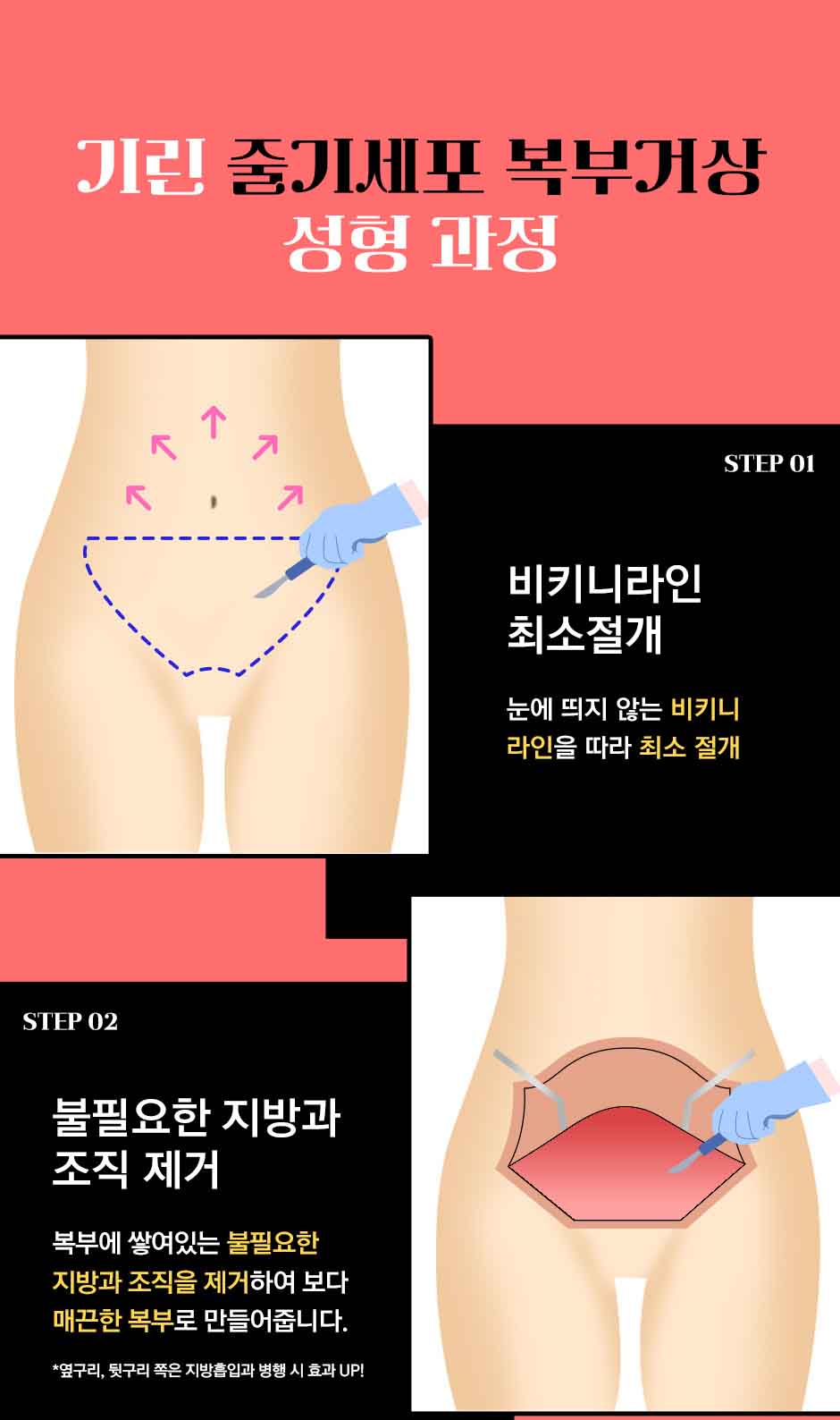 줄기세포복부거상_미인하이_07.jpg