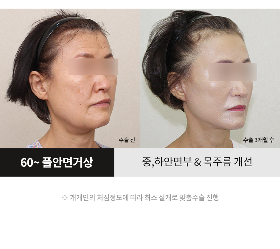 안면거상_04.jpg