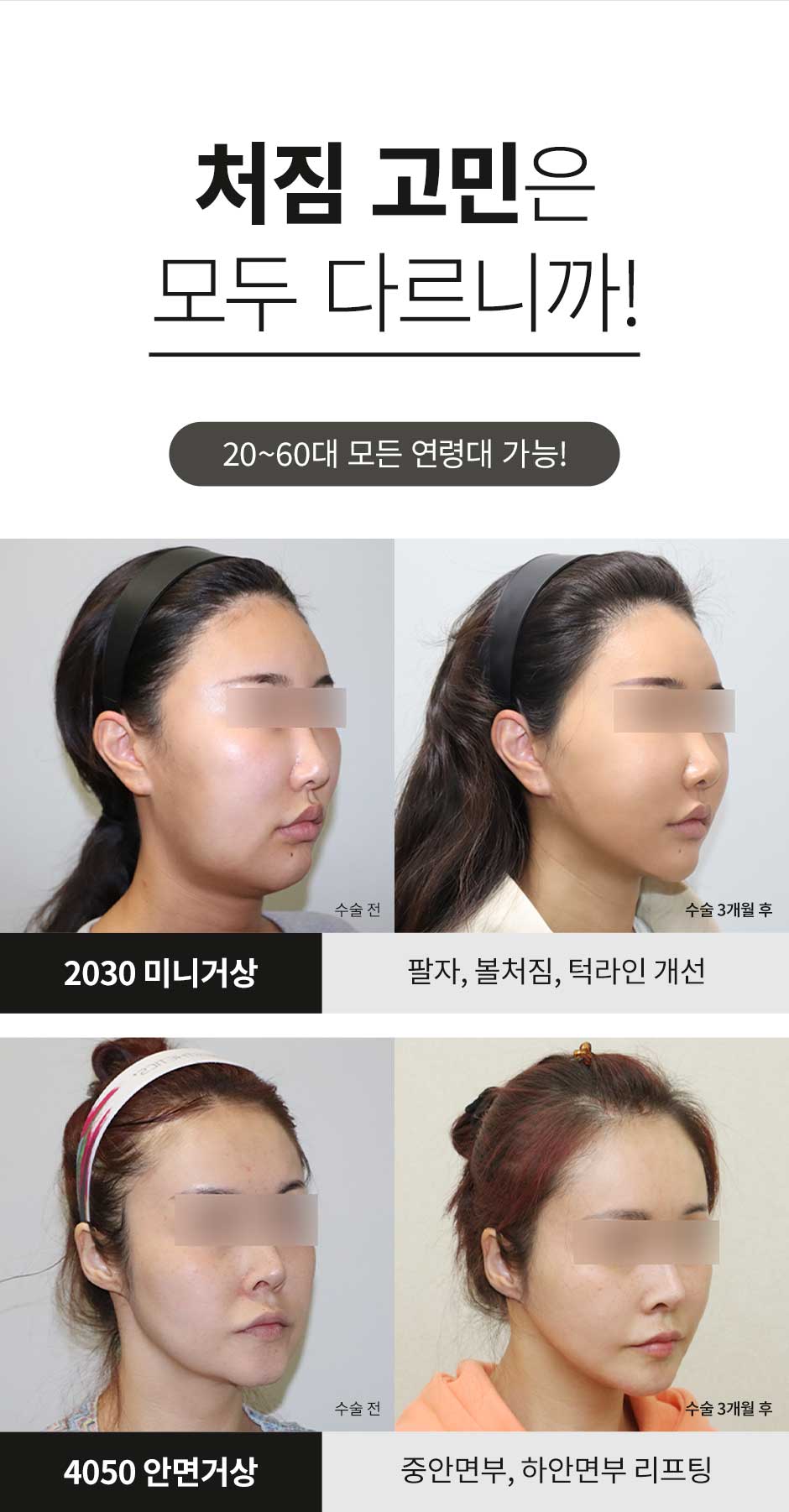안면거상_03.jpg