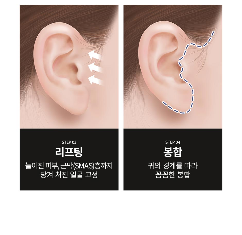 안면거상_09.jpg