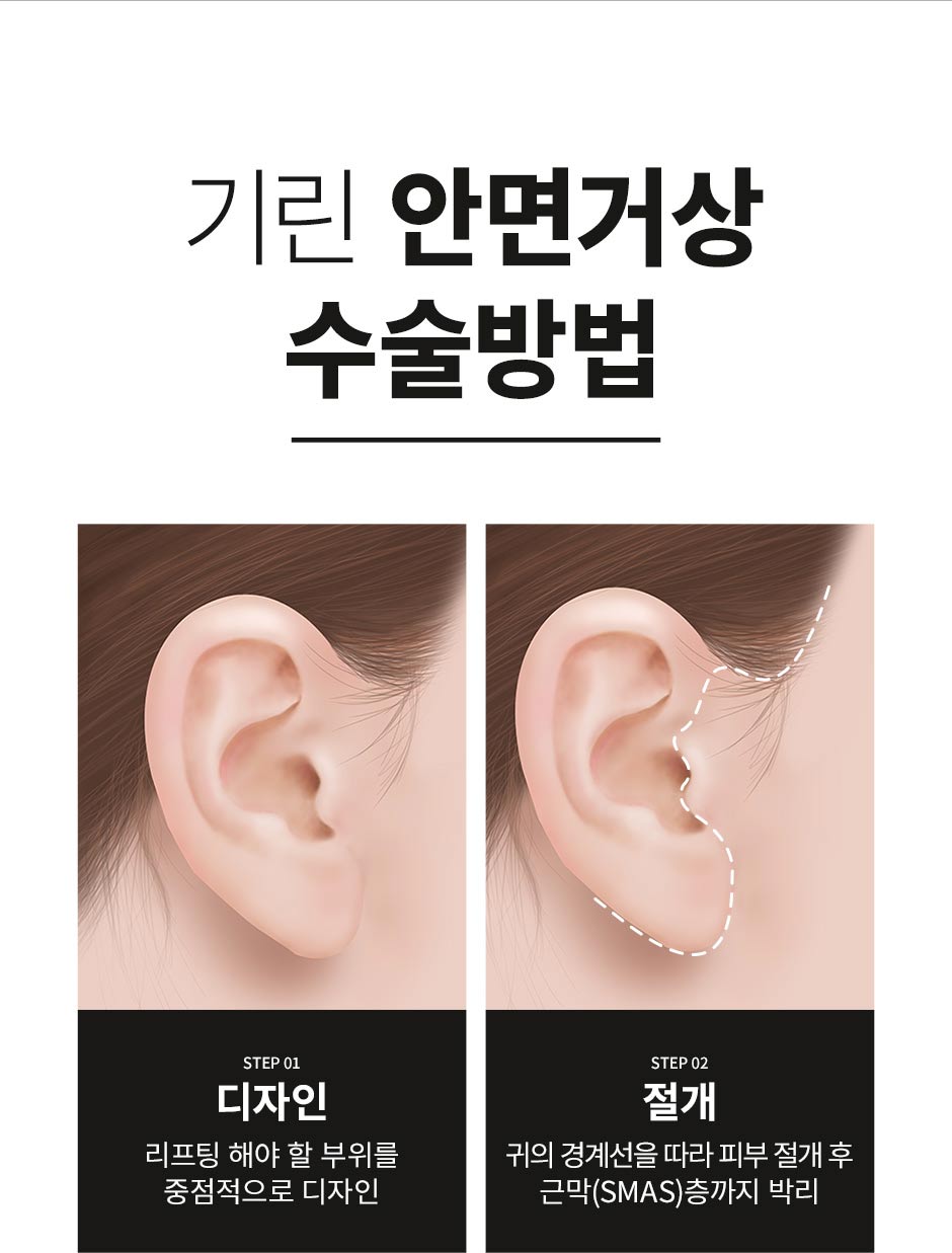 안면거상_08.jpg