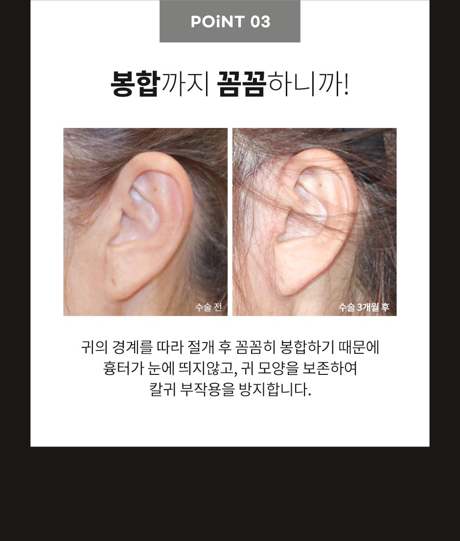 안면거상_07.jpg