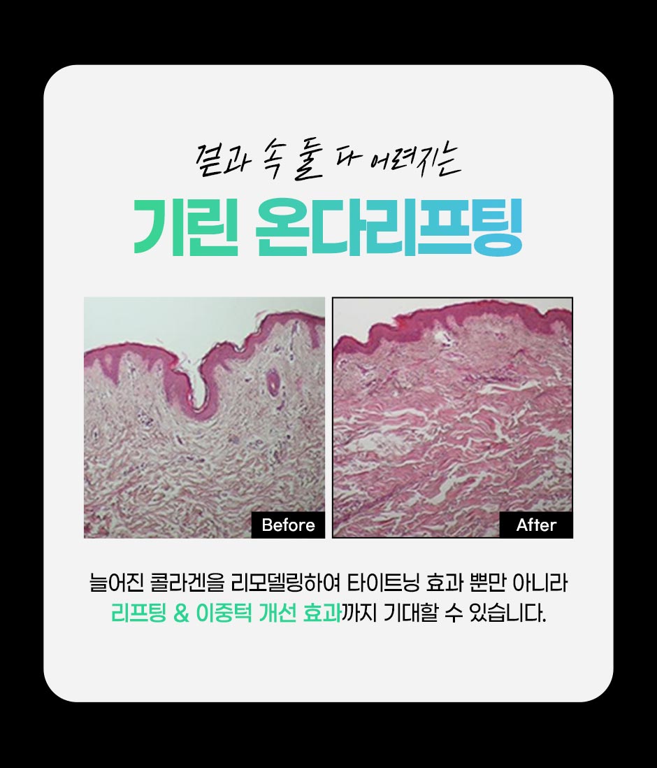 온타리프팅_07.jpg