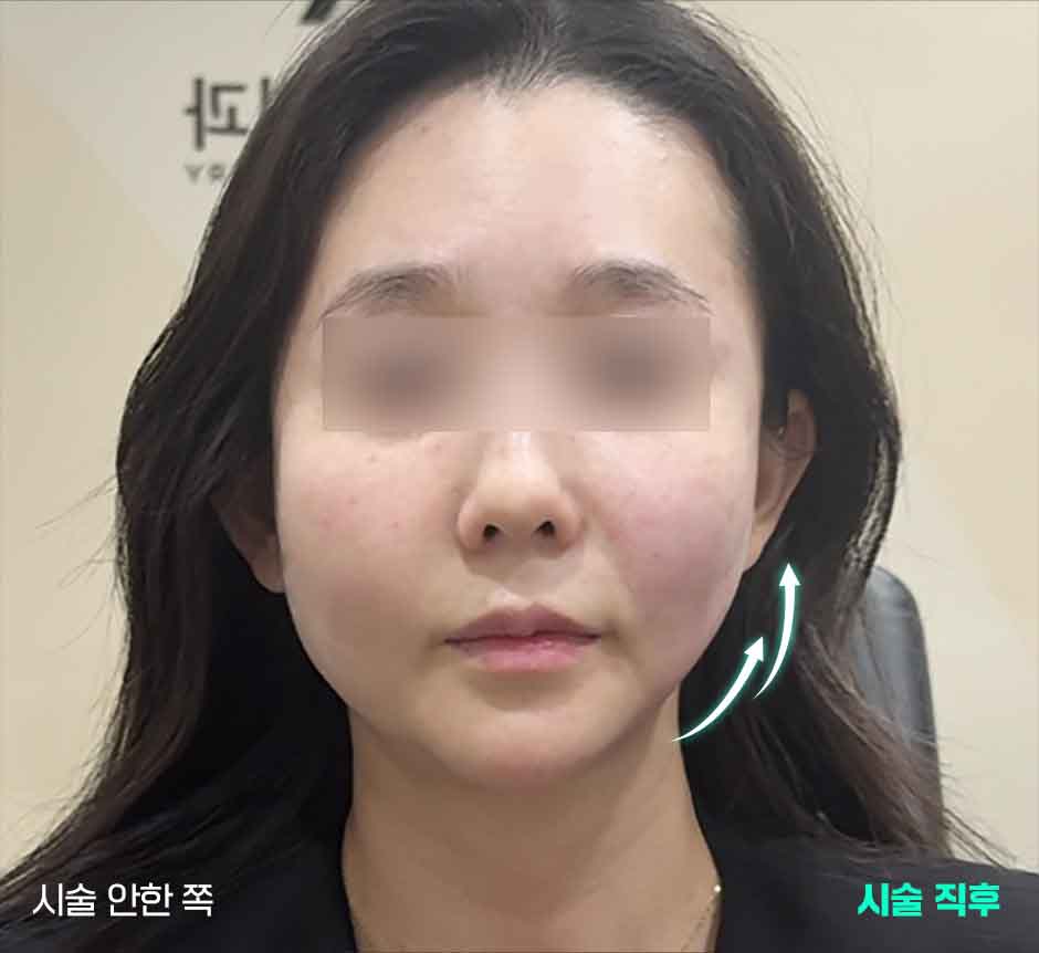 티타늄리프팅_미인하이_09.jpg