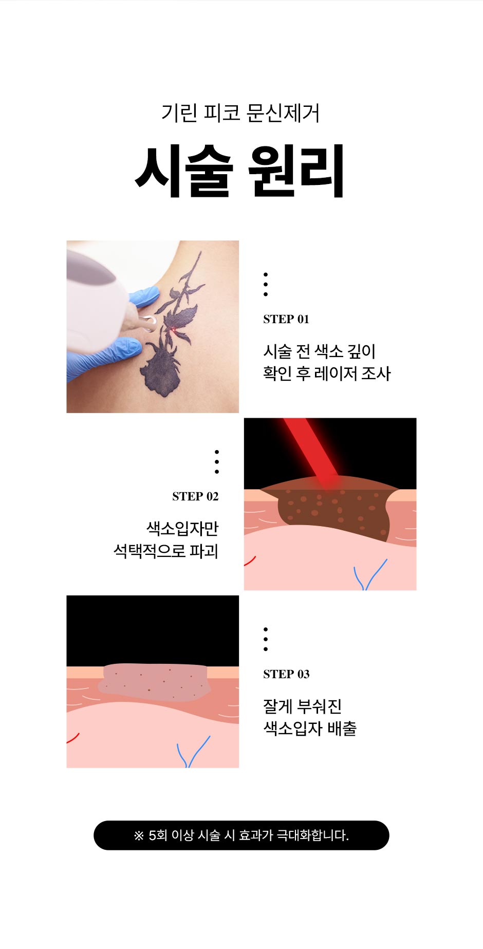 피코문신제거_06.jpg