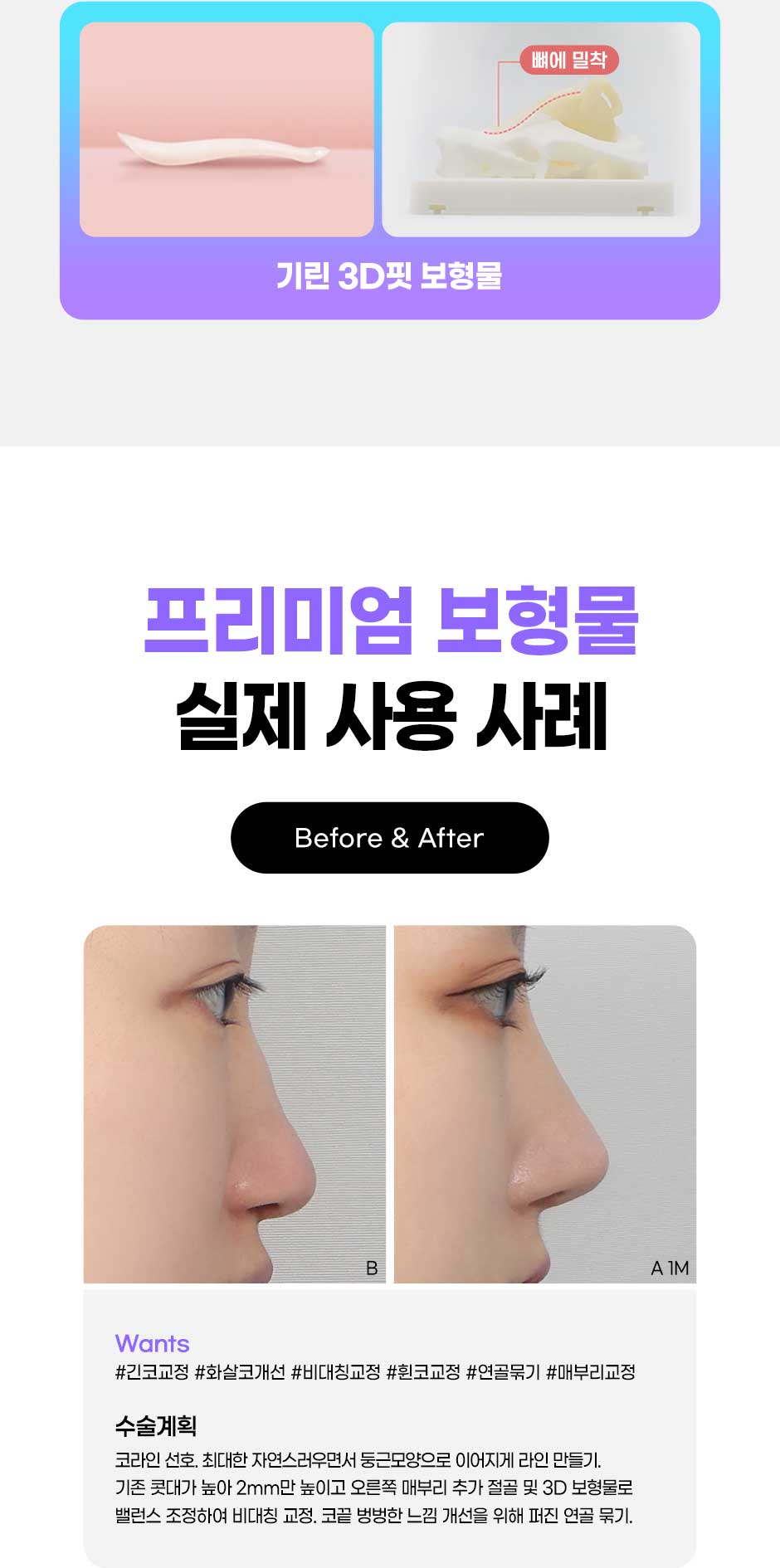 프리미엄보형물코성형_03.jpg