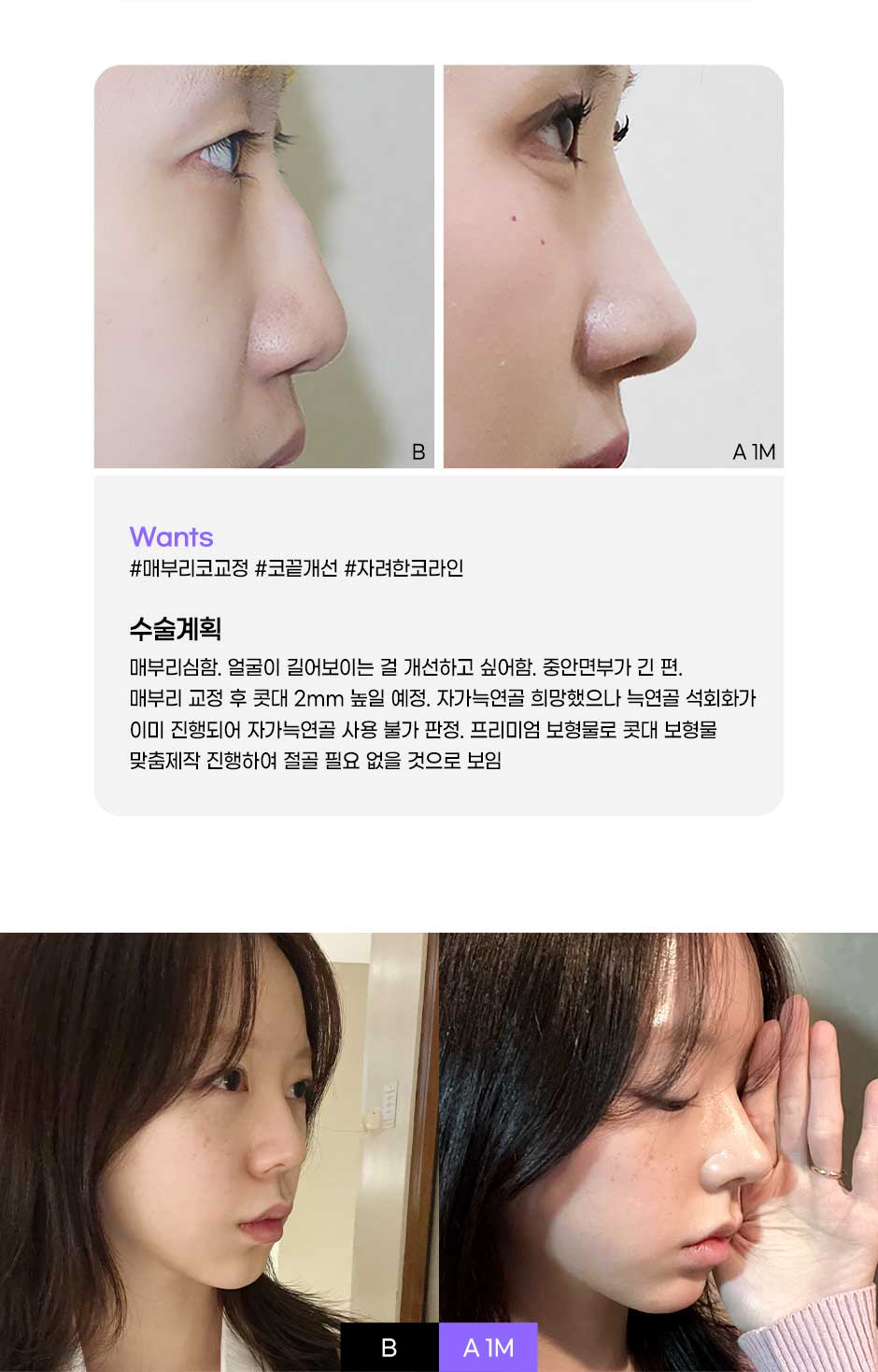 프리미엄보형물코성형_04.jpg