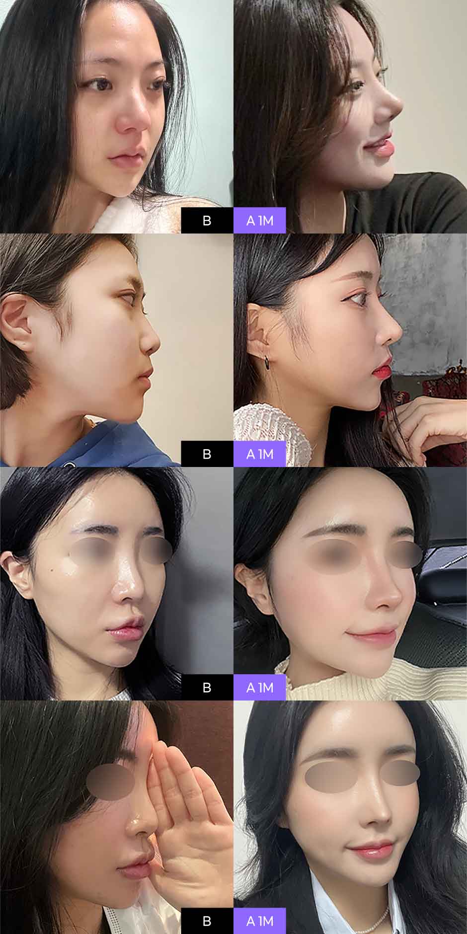프리미엄보형물코성형_05.jpg