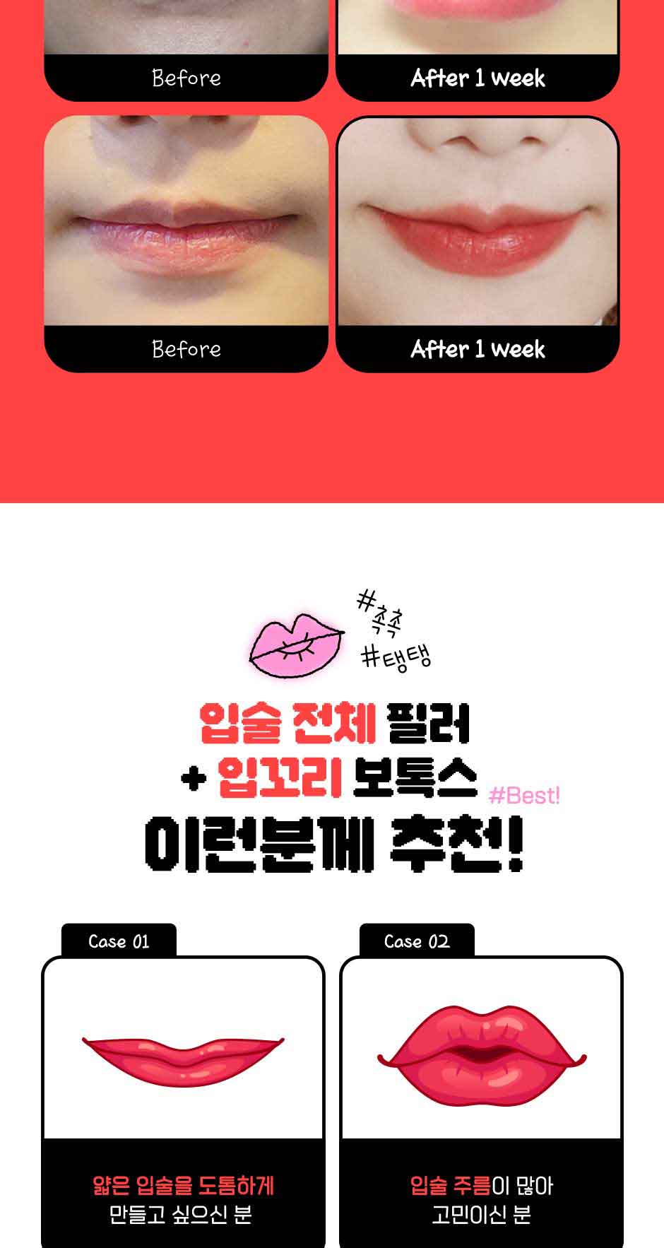 입꼬리입술필러_미인하이_05.jpg