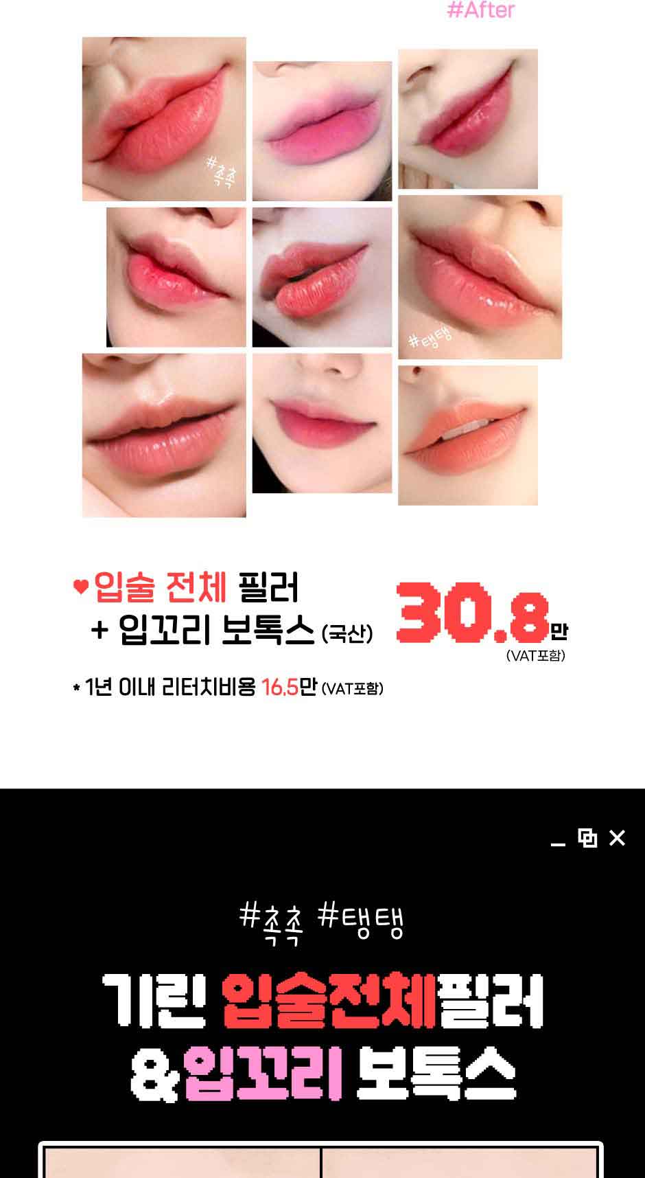 입꼬리입술필러_미인하이_02.jpg