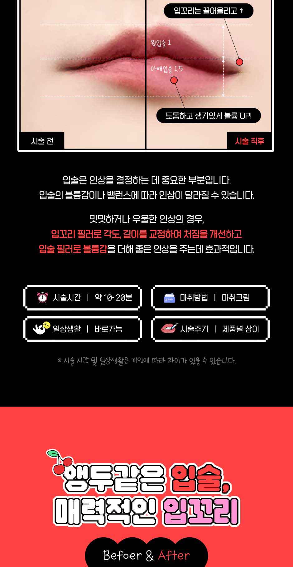 입꼬리입술필러_미인하이_03.jpg