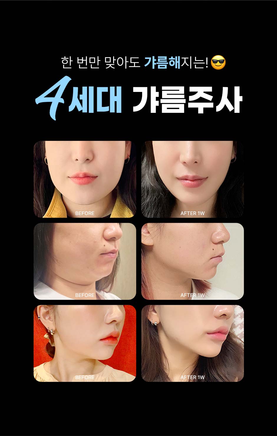 얼굴갸름주사_08.jpg