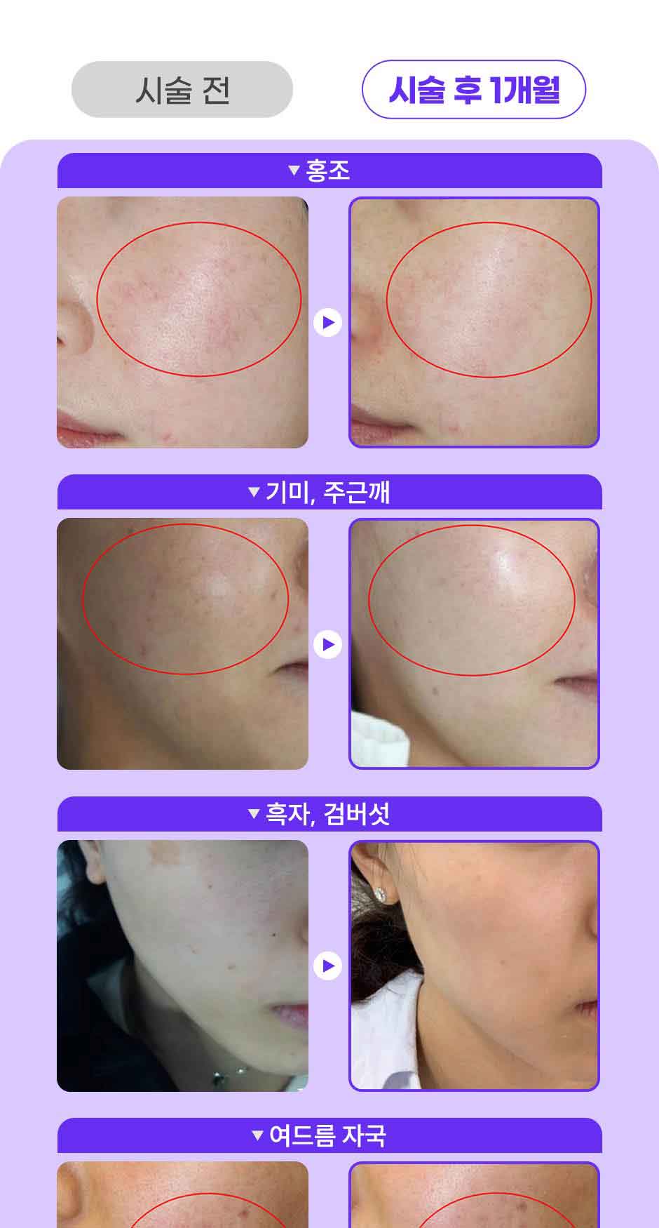 파이브레이저_미인하이_03.jpg