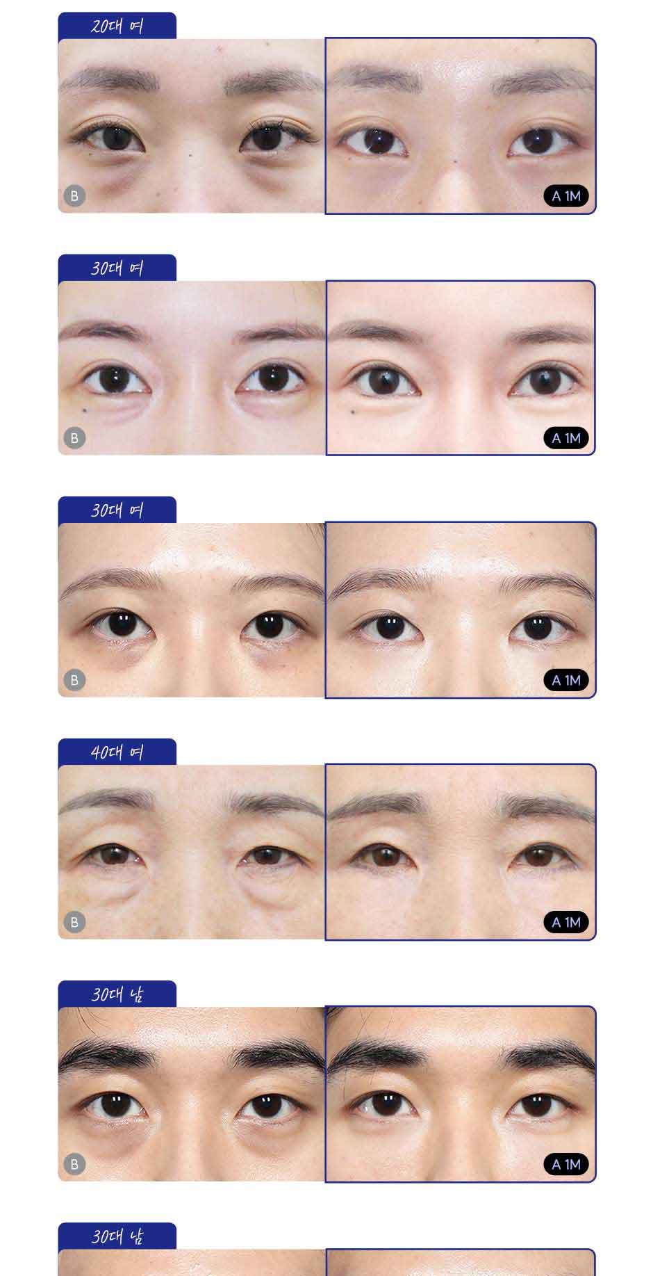 눈밑지방재배치_미인하이_03.jpg