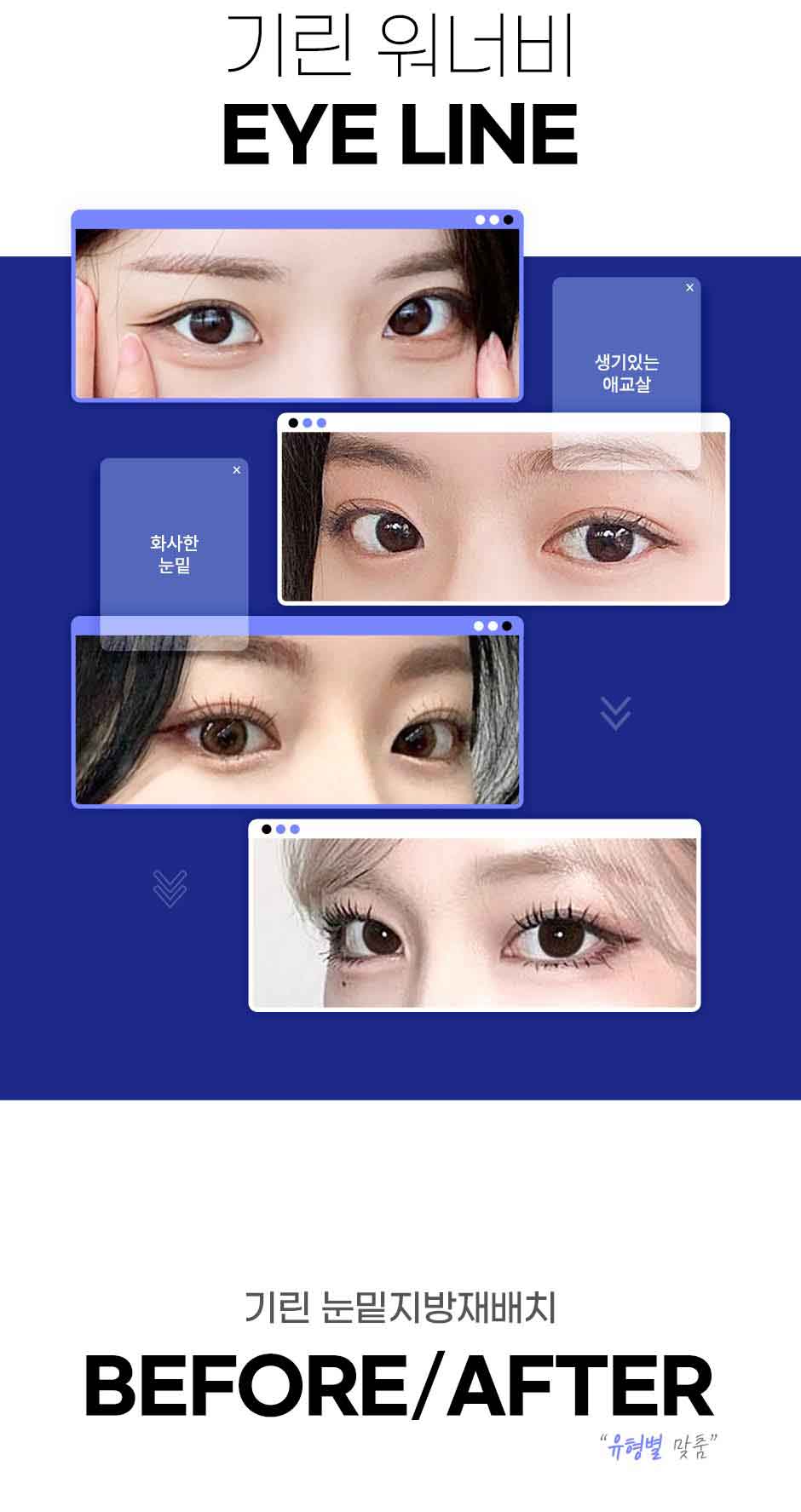 눈밑지방재배치_미인하이_02.jpg