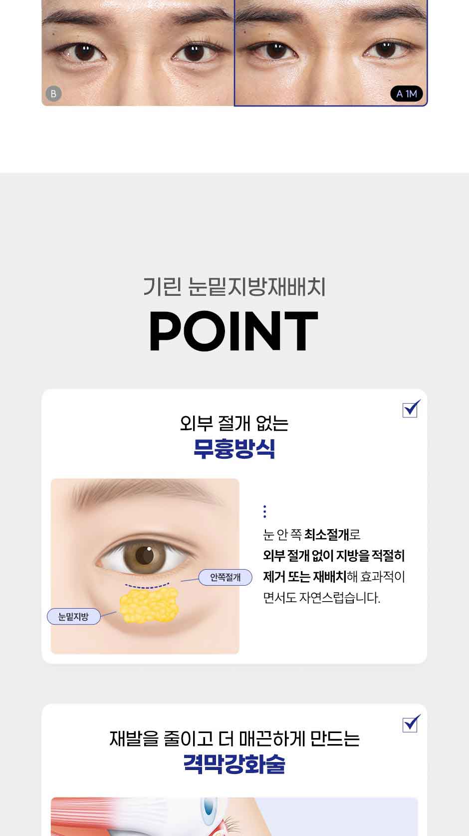눈밑지방재배치_미인하이_04.jpg