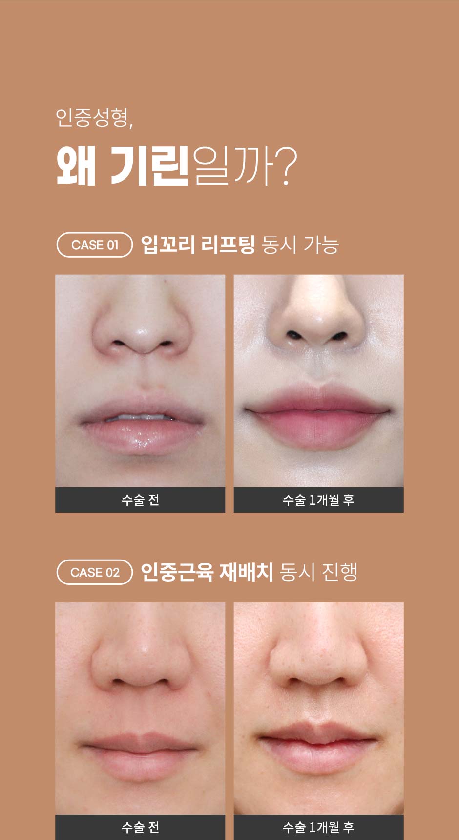 인중성형_09.jpg