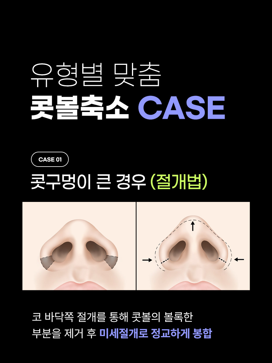 콧볼축소_05.jpg