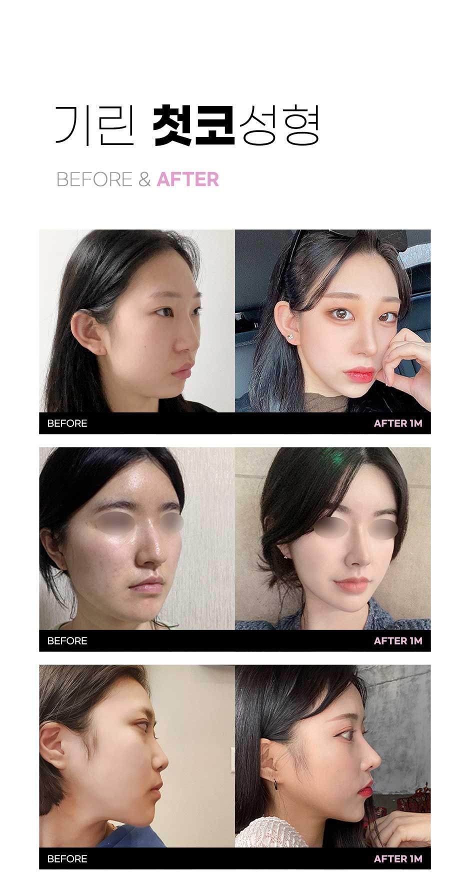 첫코성형_03.jpg