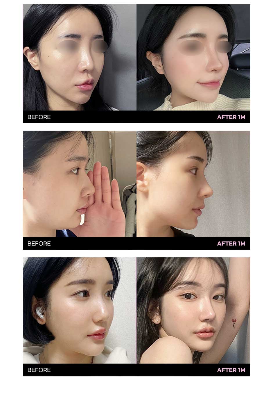 첫코성형_04.jpg