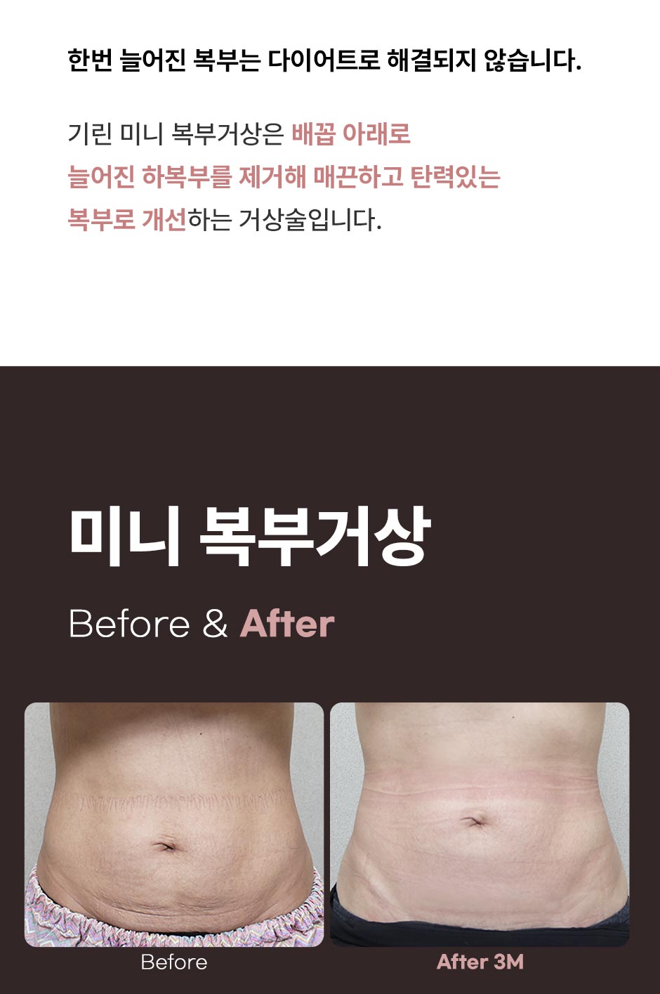 미니복부거상_미인하이_03.jpg