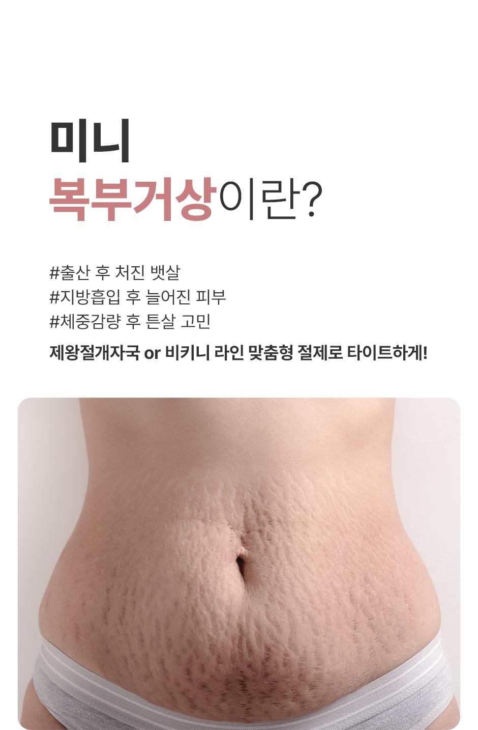 미니복부거상_미인하이_02.jpg